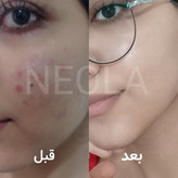 پک ضد جوش و ترمیمی نئولا