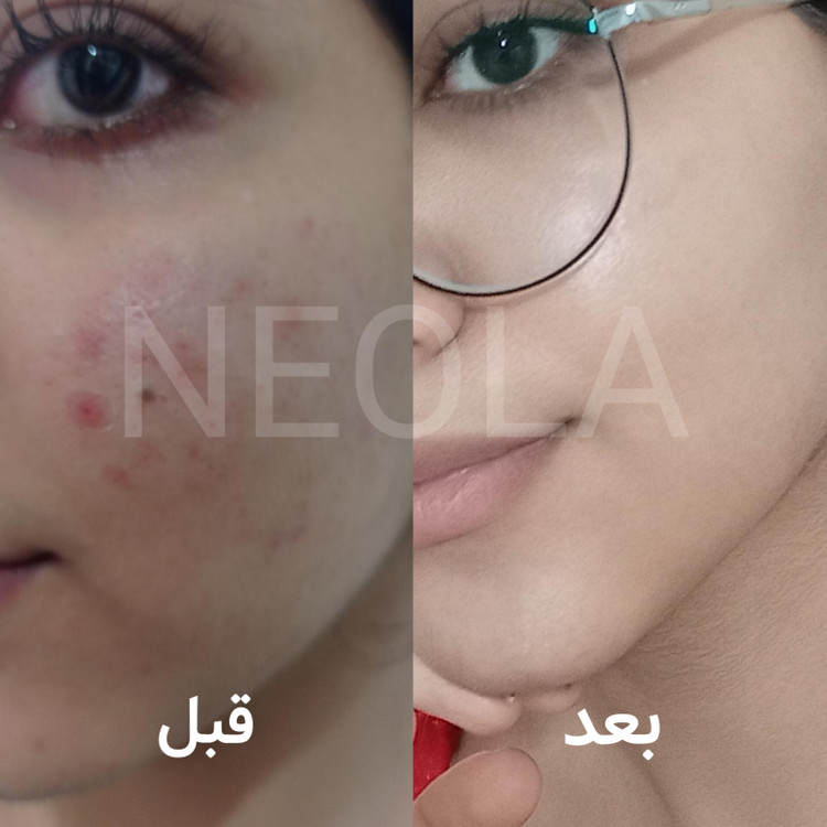 پک ضد جوش و ترمیمی نئولا